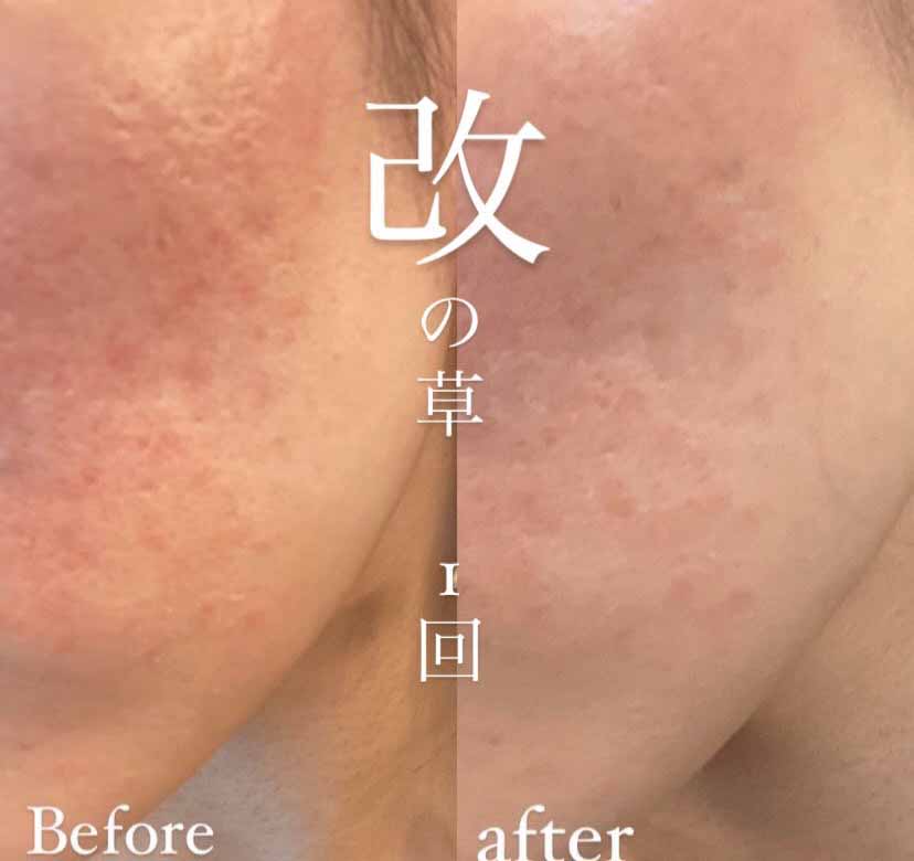 美容に特化したよもぎ蒸し、体の芯まで温まります【若よもぎ蒸し専門店